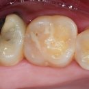 더원연합치과의원 | 달서구 치과,심한 충치가 있어도 살릴 수 있어요~!