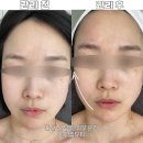 원영크레온 | 안산 선부동 피부관리 추천 : 아로벨뷰티에서 윤곽관리와 물방울관리후기