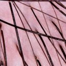 연세모에버의원 | 두번째, 탈모병원 진료 후기