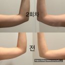 (주)하리푸드 | 신사 지방분해주사 팔뚝 제로컷 2회차, 잦은 외식 괜찮을까