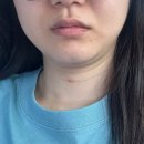 리프성형외과의원 | 이중턱 지방분해주사 1회 맞고 대만족한 후기 (feat, 리프성형외과)