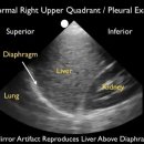 Ultrasound Detection of Pleural Fluid - SonoSite, Inc. 이미지