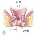 음식과 질환 - 치질 이미지