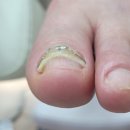 레푸스 감삼점&에이레네 | 대구 내성발톱 통증 없이 해결하고 온 후기