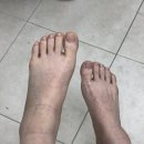 파주제일한의원 | 골절환자의 인생 첫 입원일지/성남 정병원/산재처리과정/골절 환자 단기입원시 준비물/추천비추천 후기