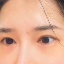 메이성형외과의원 | 부산 서면 눈 수술 (눈 지방재배치, 복합 트임,) 리얼 솔직한 찐 후기 1탄