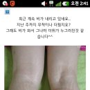 나진짜200마넌모아서바로종아리튼살치료할거야ㅠ이거봐(혐) 이미지