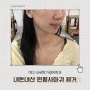 2023-0006 | 대구편평사마귀 제거, 신세계가정의학과 내돈내산 후기 변화과정 듀오덤X