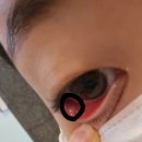 SU연세안과의원 네이버블로그