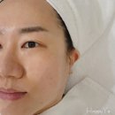 안티안의원 | 청담동 리프팅잘하는곳, 안티안의원 얼굴체외충격파 솔직후기