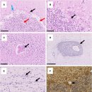 Re: gluten ataxia - 글루텐 운동실조... 2024년 이미지