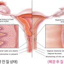 질건조증[Vaginal dryness] 이미지