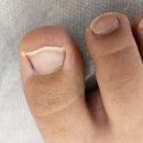 아이풋네일 | 대구 문제성 발톱 관리 대구 서구 내성발톱 클린풋네일