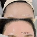소답동175 | (창원왁싱) 이마의솜털정리만해도 보톡스맞은효과 볼수있는 헤어라인왁싱😉