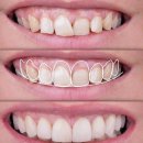 해피스마일치과의원 | &#34;웃고 싶지만 잇몸은 보여주기 싫어요&#34; 거미스마일을 해피 스마일로 바꾸는 잇몸성형 안내!