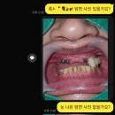 모델리스 치과기공소 | 모델리스 제작 치과기공소 #구강스캔 #모델리스
