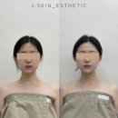 더제이메디칼 | 대구 동성로 피부관리 제이스킨 데콜테 작은얼굴 에스테틱 후기 예신 추천