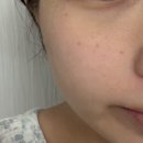 청담온누리약국 | [ 제품 리뷰 ] 프락셀 후 예민해진 피부장벽 EGF 재생크림으로 관리하기 ( feat . 지피덤 EGF 스킨...