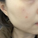 신매근린공원 | 대구 수성구 시지 피부과 대구 리팟 레이저 리얼 내돈내산 후기 리쥬엘의원수성점