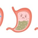 속쓰림·신물 넘어옴·목 이물감…이 질환 발병 가능성도 이미지