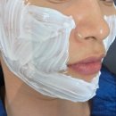 크림성형외과의원 | 강남 신논현역 비올라셀성형외과 에서 울쎄라 300샷 시술 리얼 솔직 후기 (내돈내산) 후기!