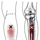 후경골근(tibialis posterior) 이미지