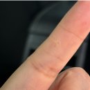 생기한의원 | 대전 생기한의원 사마귀 치료 후기
