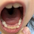 사과나무치과병원 | [공지] [주엽 사과나무치과병원] 초등아이 유치뽑기, 사과나무치과에서 잘 끝냈어요