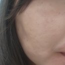 마산피부과추천-리쥬란HB +일반리쥬란 섞어서 맞은 내돈내산후기 통증비교