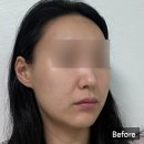 더400 | 청담 피부과 올타이트리프팅 400샷 후기,심부볼 팔자주름 고민해결한 청담동 리프팅 추천