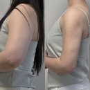 멍스타일 | 대구 팔뚝지방흡입 당일부터 한달까지 변화 후기 (붓기, 멍, 통증)