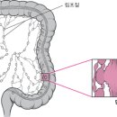 ■결장직장암 이미지