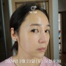 해날피부과의원 | 김포 구래동 피부과 쥬베룩 포텐자 1회시술후 1~2주차경과후기