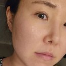 화명동 피부과 :: 홍조레이저 + 스킨부스터 치료 후기