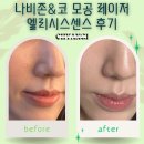 나비존&amp;코 모공 레이저 엘리시스센스 후기 / 모공&amp;블랙헤드 없애는법