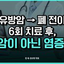 전이 폐암 극복!암 환자의 놀라운 성공 치료 사례 이미지