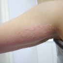 정재윤한의원 | 부산 튼살치료-서면 미엘르피부과