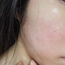 여름철 피부트러블 여드름에는 헥사더말 전신 피부 살균 보습제