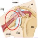 어깨통증 충돌증후군 이미지