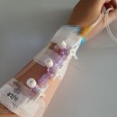 안암2 | psvt 전극도자절제술 고대 안암 병원 후기 2.