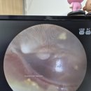 모산방 | 단국대병원 28개월아기 진주종제거 수술 후기/이비인후과/소아병동 1인실