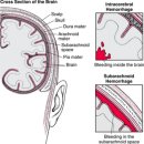 중풍(뇌졸중)의 원인과 예방과 치료(2) 이미지