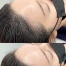 선헤어라인 이미지