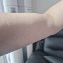 백천피부과 | 홈모드 써마 리프트 10주차 사용 후기