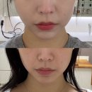 씨유 안산중앙역에코점 | [안산피부과추천 - 온다리프팅 시술 후기] 안산 중앙역 피부과 온다리프팅 내돈내산 솔직후기