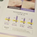 주식회사 나노바이오시스템 | 여드름패치 추천 후기｜턱밑 뾰루지·아들 여드름, 셀로잇 나노패치