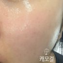 [인천 구월/더마티스트의원]아포지플러스 얼굴전체 제모 후기/내돈내산(2)/부작용, 화상 후기
