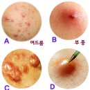 여드름 짤까 말까, 모낭염 원인과 치료법. 이미지