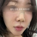 달 | 세르프 볼패임 걱정했는데... (300샷 한달 후기)