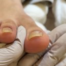 레푸스송탄점 | ┃평택내성발톱 파고드는 발톱 레푸스송탄점에서 관리 받은 후기